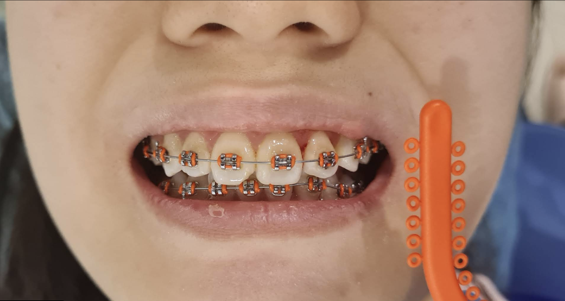 Braces & Orthodontics