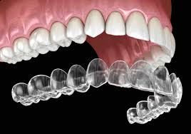 Tooth Extraction & Wisdom Teeth